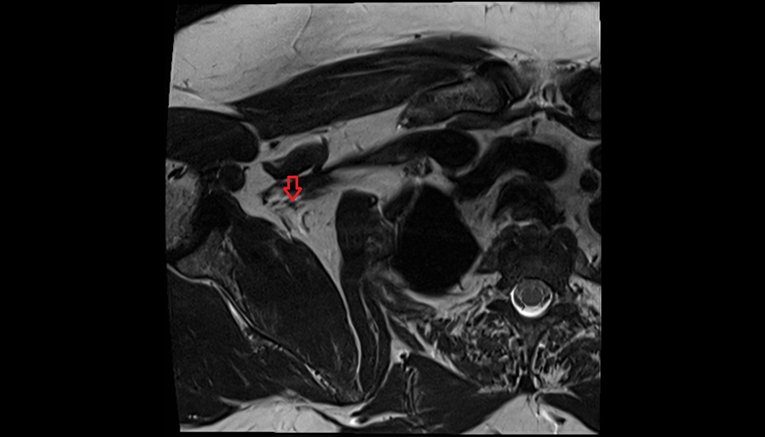Brachial plexus  anatomy MRI axial  image -img-00000-00000_00002