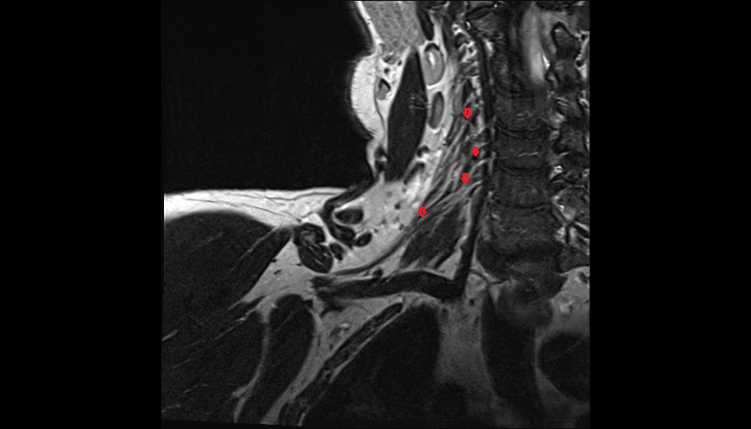 Brachial plexus  anatomy MRI coronal  image -img-00000-00000