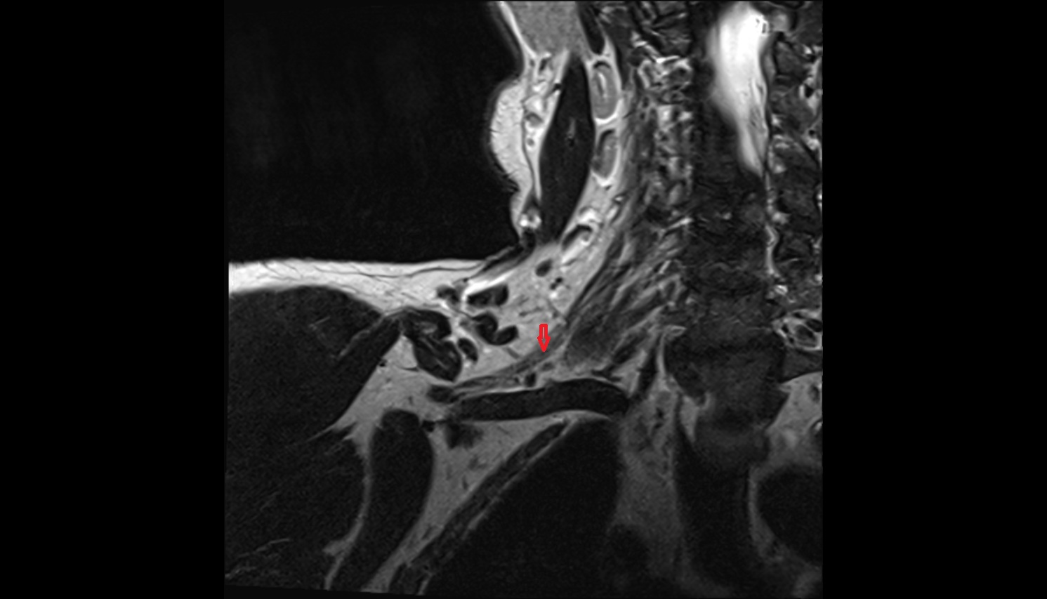 Brachial plexus  anatomy MRI coronal  image -img-00000-00000_00001