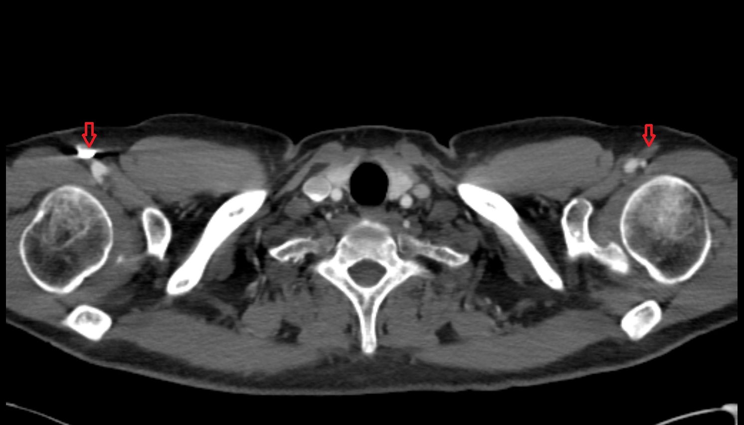 Brachial veins anatomy  CT axial  image -img-00000-00000