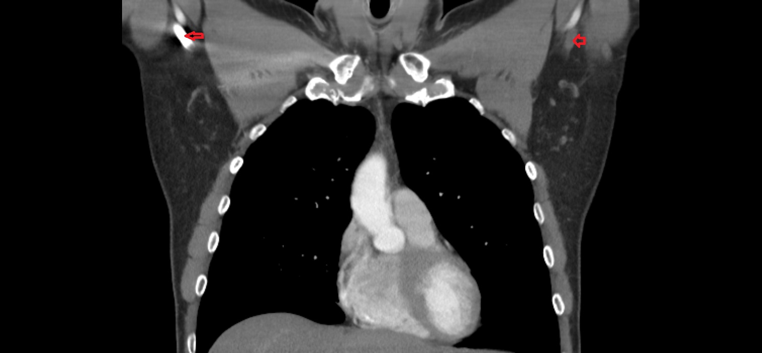 Brachial veins anatomy  CT coronal  image -img-00000-00000