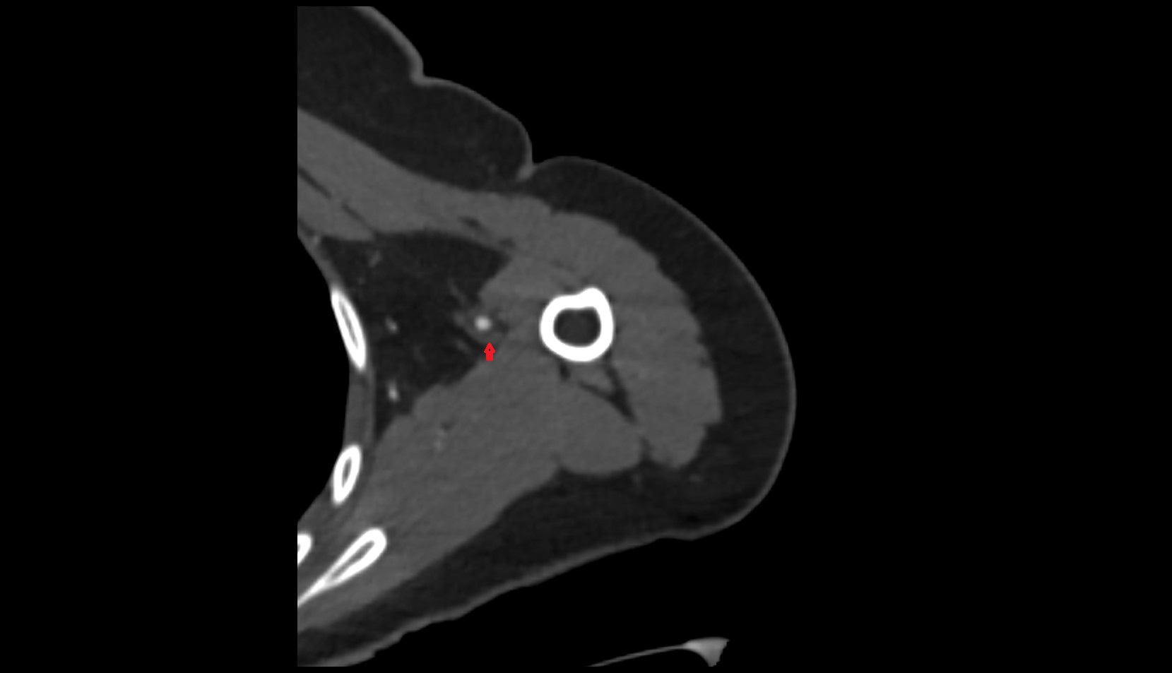 Brachial veins ct axial