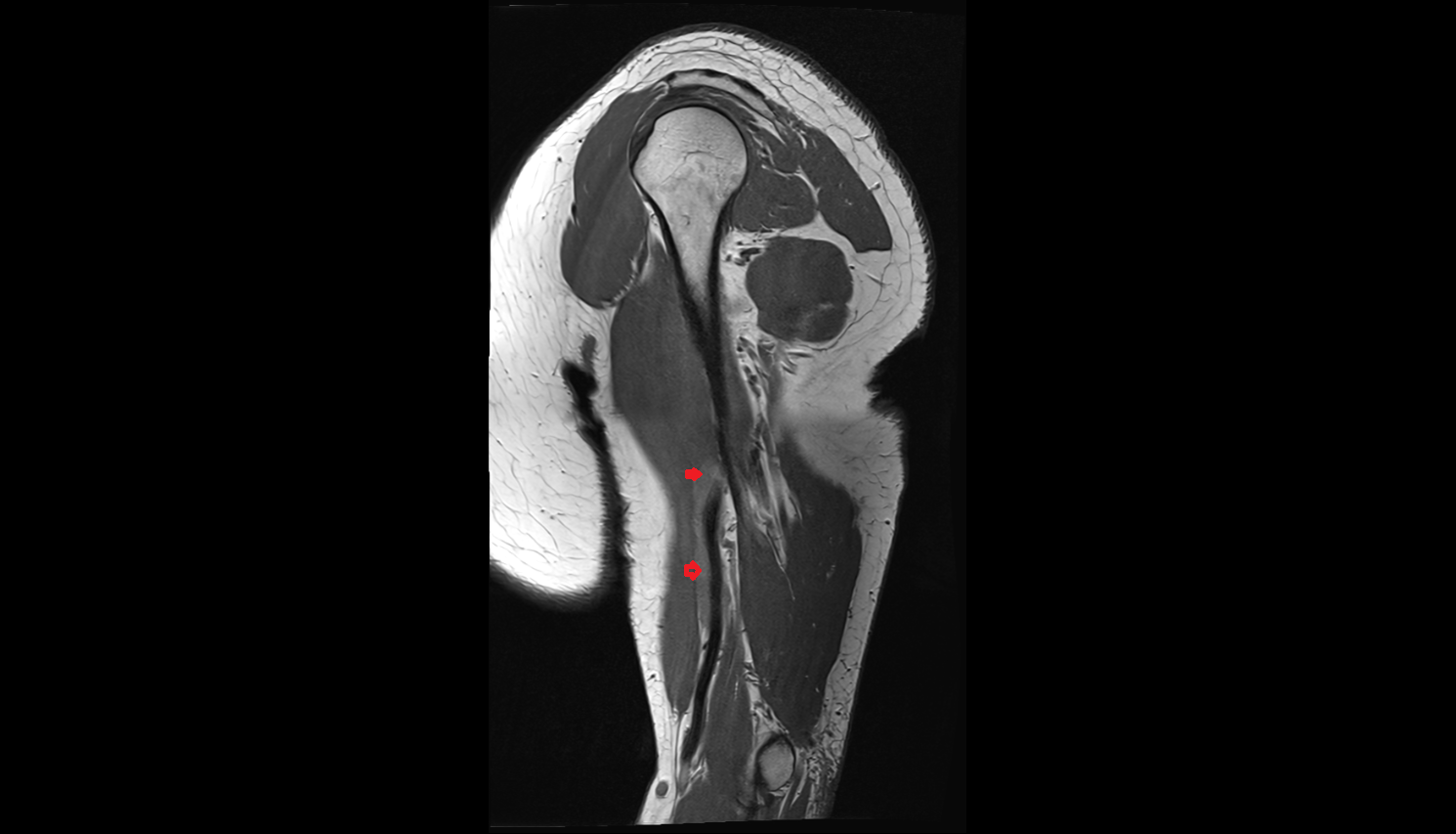 Brachial veins sag cross sectional anatomy 3T MRI AI enhanced radiology image-img-00000-00000
