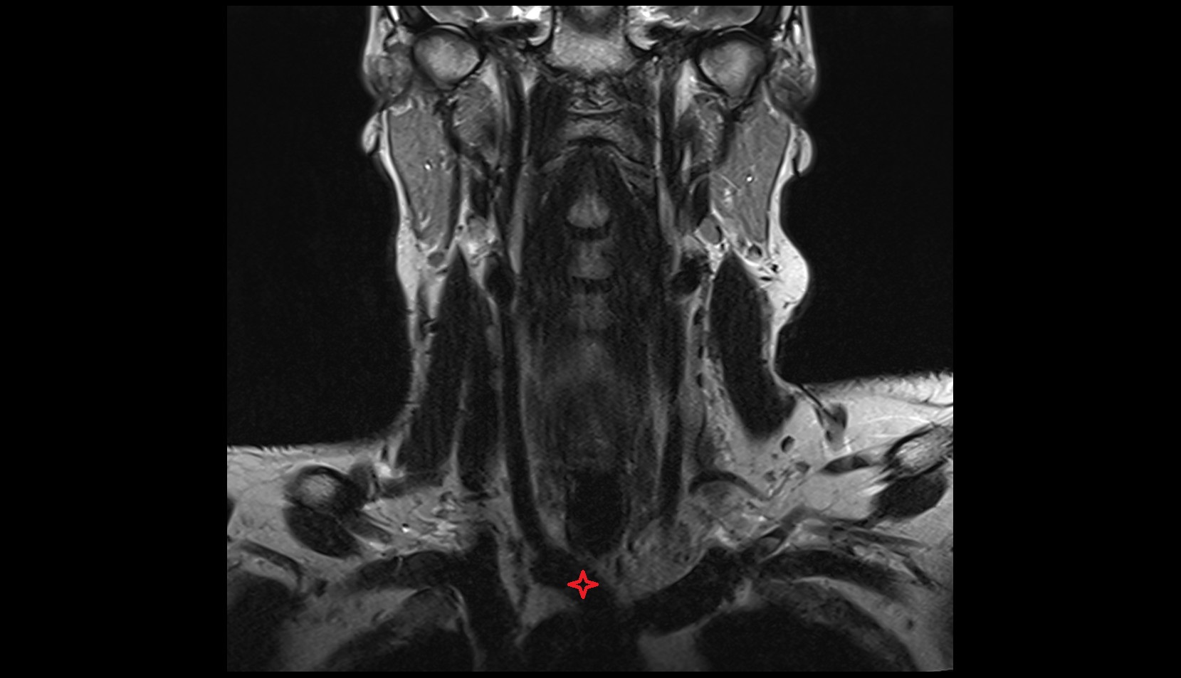Brachiocephalic trunk MRI coronal t2 image