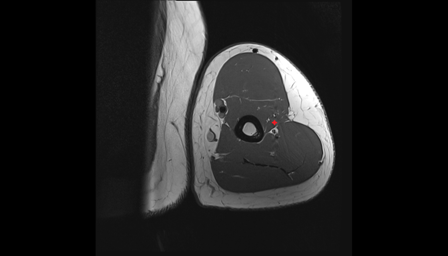 Brachioradialis muscle  axial cross sectional anatomy 3T MRI AI enhanced radiology image -img-00000-00000
