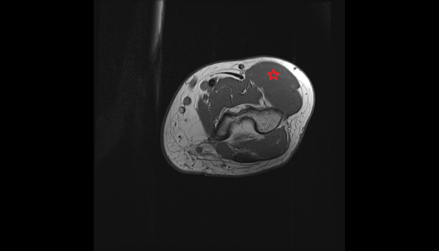 Brachioradialis muscle  axial cross sectional anatomy 3T MRI AI enhanced radiology image -img-00000-00000_00001