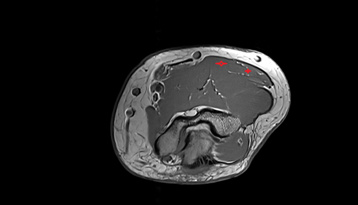 Brachioradialis muscle  axial cross sectional anatomy 3T MRI AI enhanced radiology image -img-00000-00000_00002