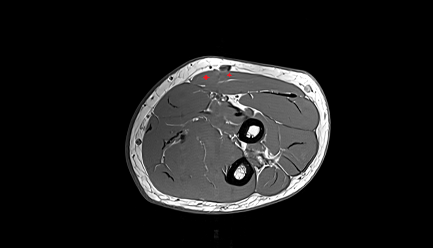 Brachioradialis muscle  axial cross sectional anatomy 3T MRI AI enhanced radiology image -img-00000-00000_00004