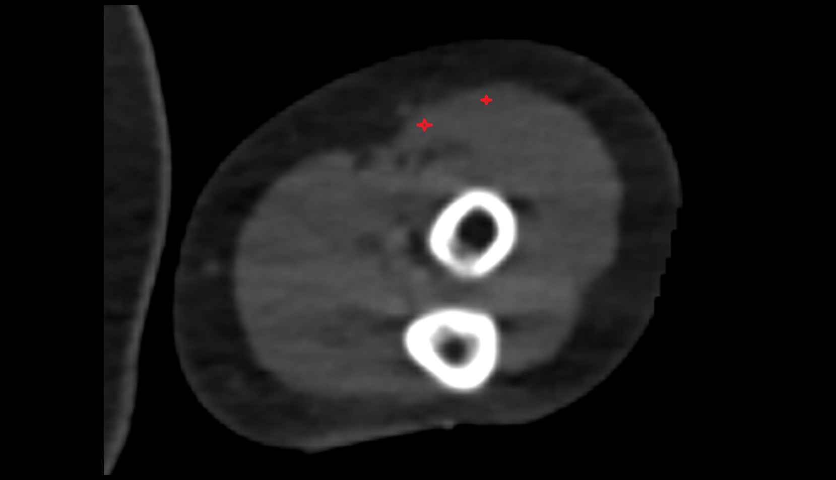 Brachioradialis muscle ct 2