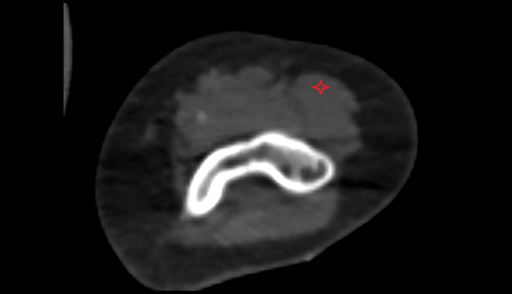 Brachioradialis muscle ct axial