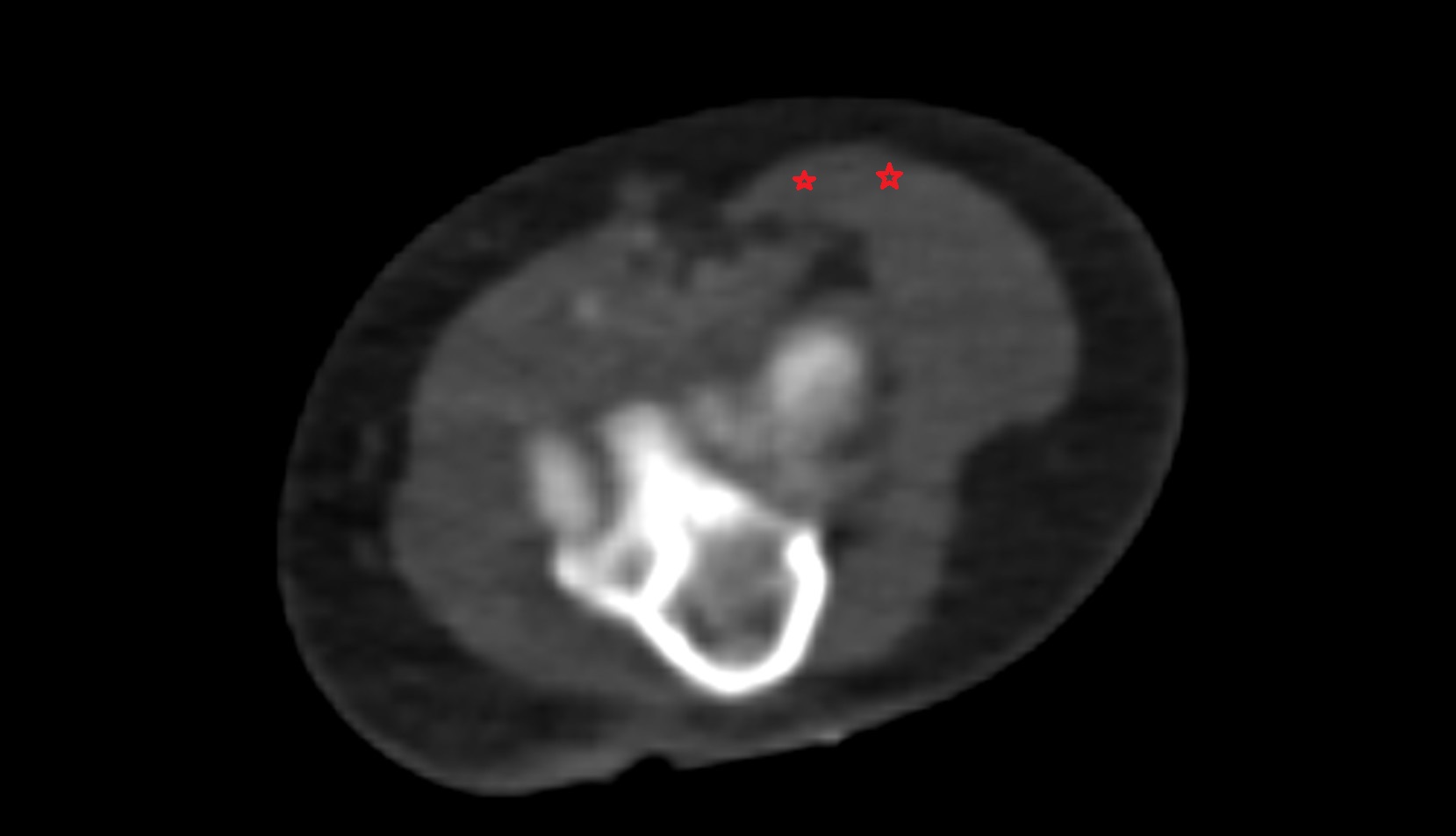 Brachioradialis muscle ct axial 1