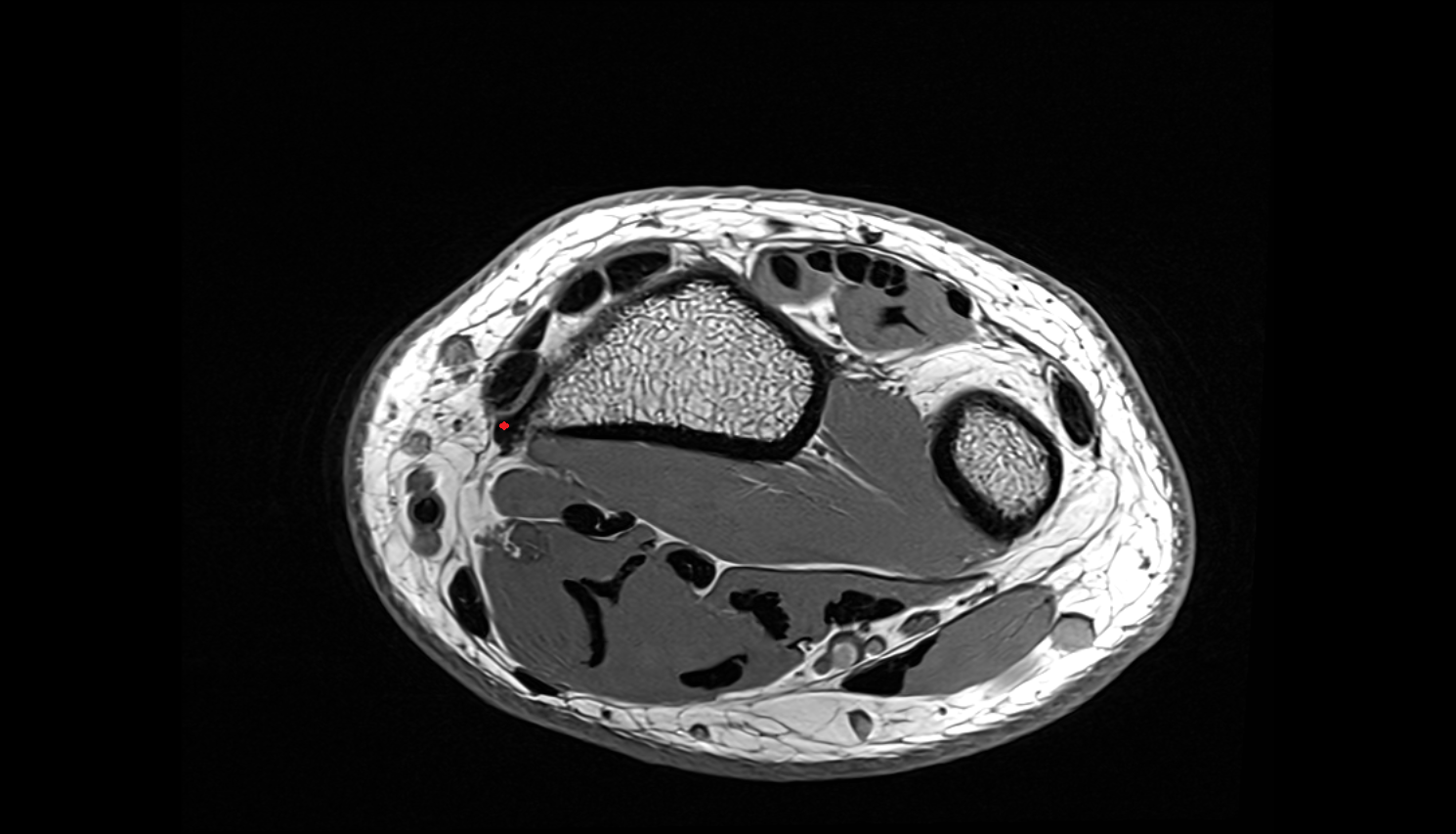 Brachioradialis tendon axial cross sectional anatomy 3T MRI AI enhanced radiology image-img-00000-00000