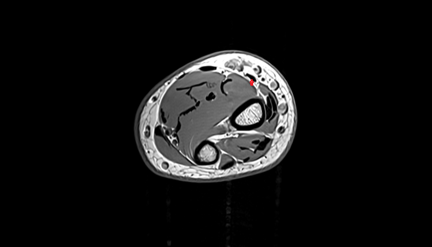 Brachioradialis tendon axial cross sectional anatomy 3T MRI AI enhanced radiology image-img-00000-00000_00002