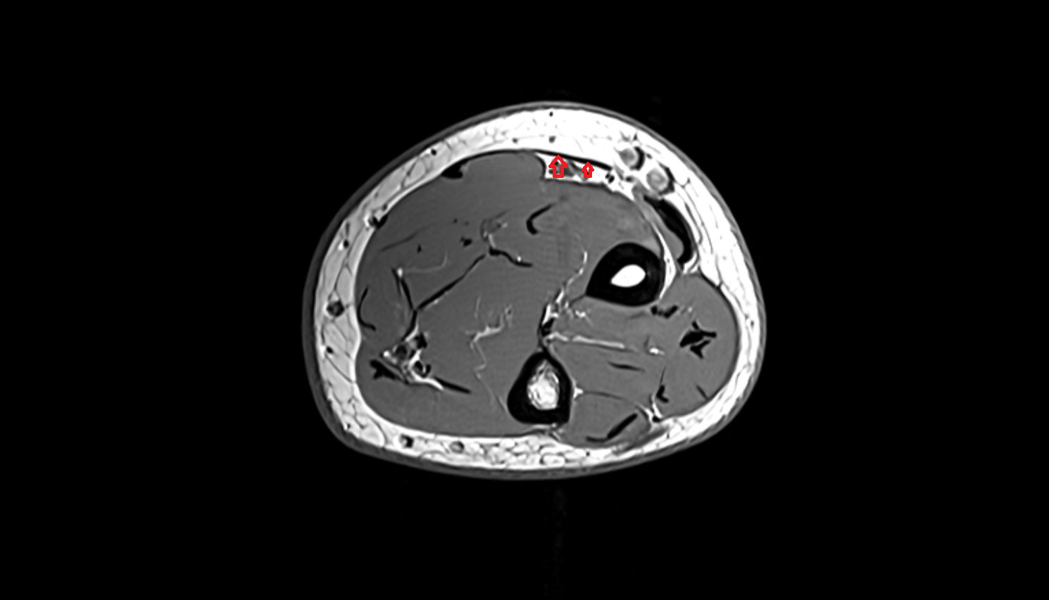 Brachioradialis tendon axial cross sectional anatomy 3T MRI AI enhanced radiology image-img-00000-00000_00003
