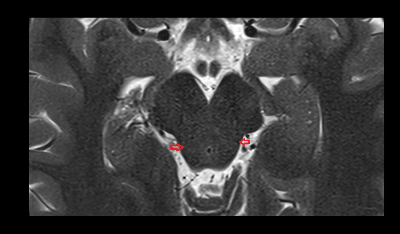 Brachium of inferior colliculus mri axial image