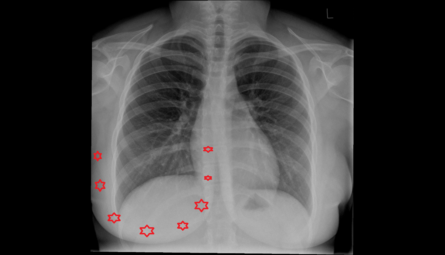 Breast shadow  X ray Anatomy, Location and Imaging Appearance  -img-00000-00000
