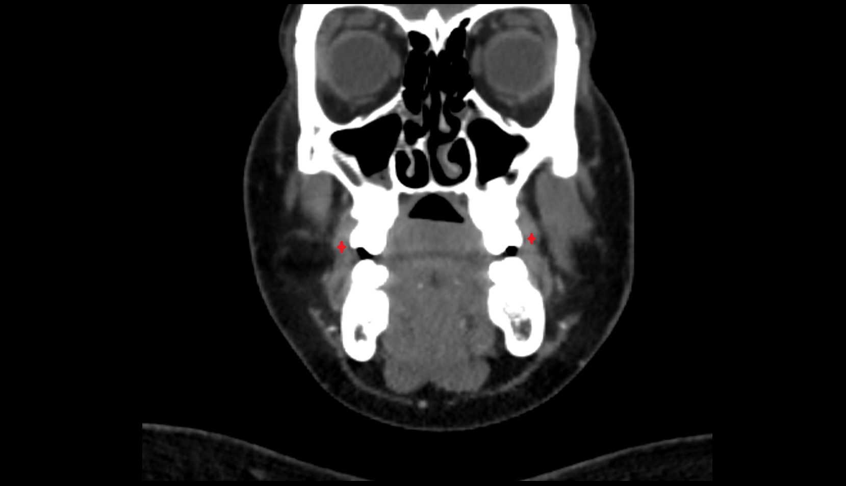 Buccinator muscle CT CORONAL
