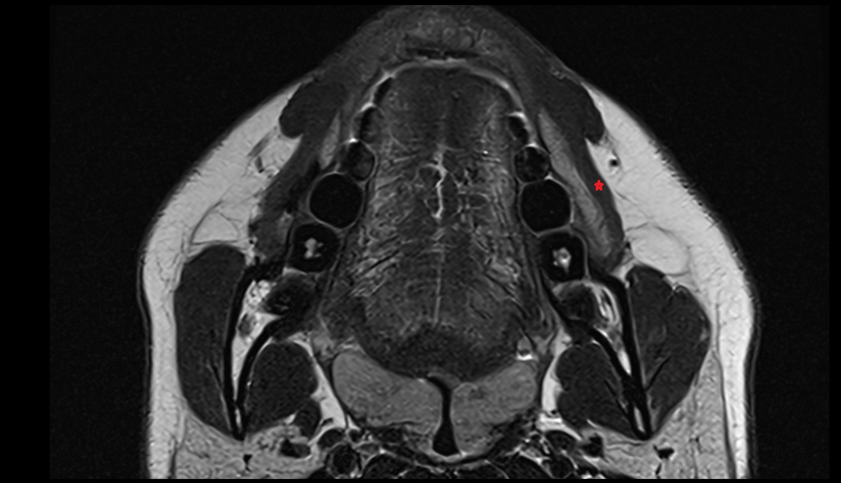 Buccinator muscle axial image