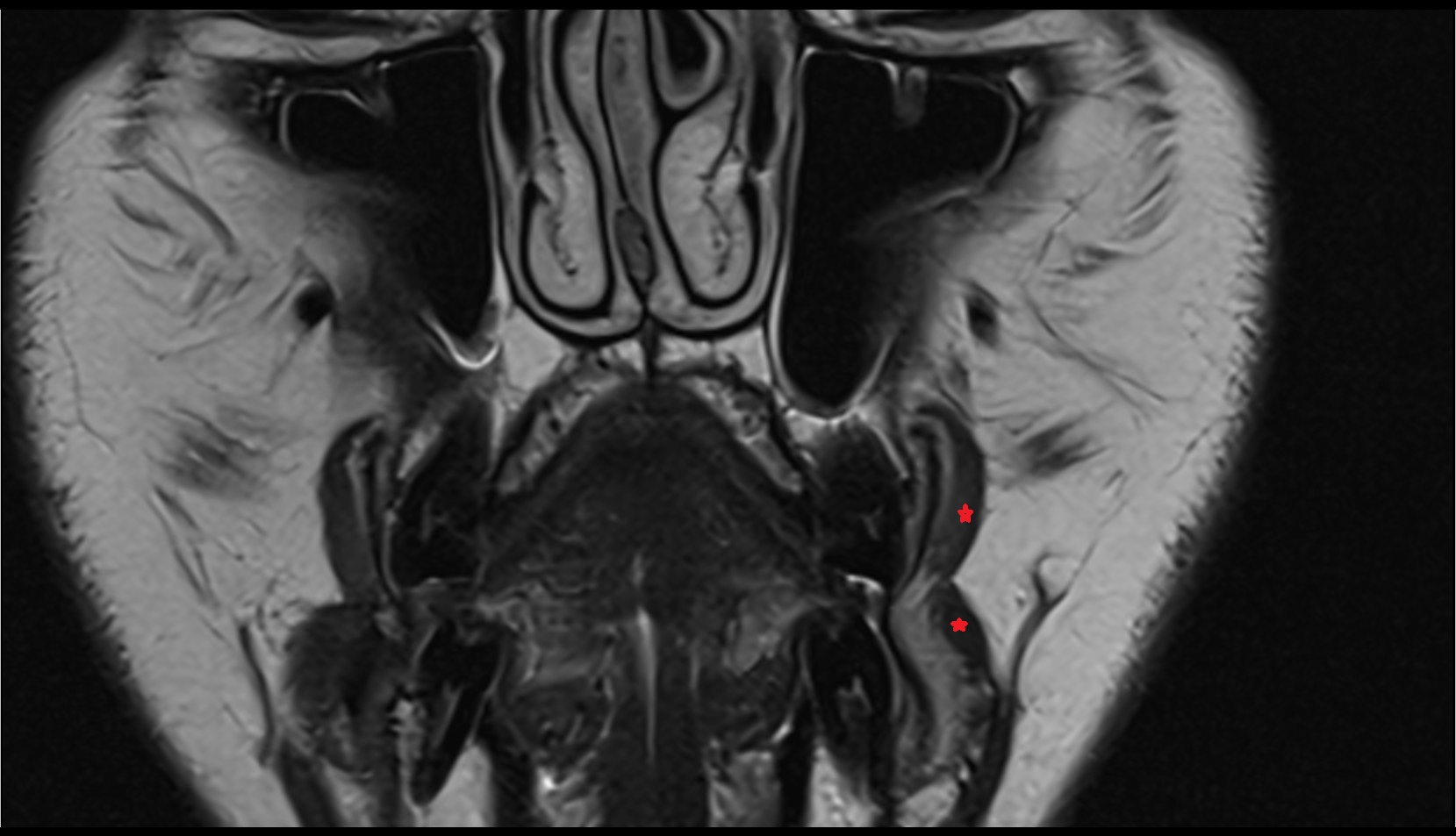 Buccinator muscle coronal mri image