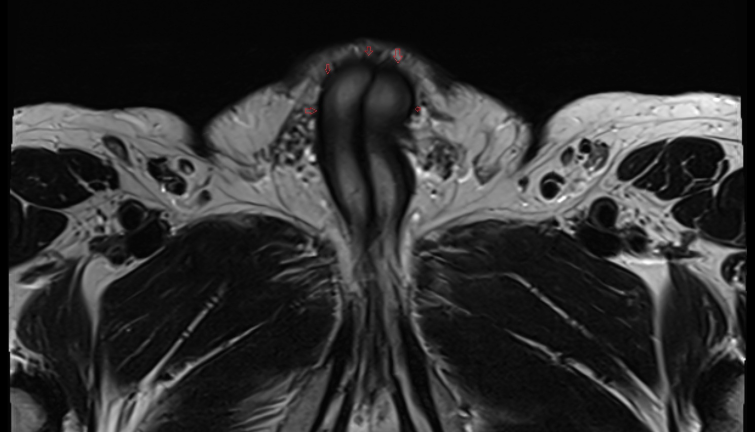 Buck's fascia  (Deep fascia of penis)  mri axial  anatomy  image-img-00000-00000