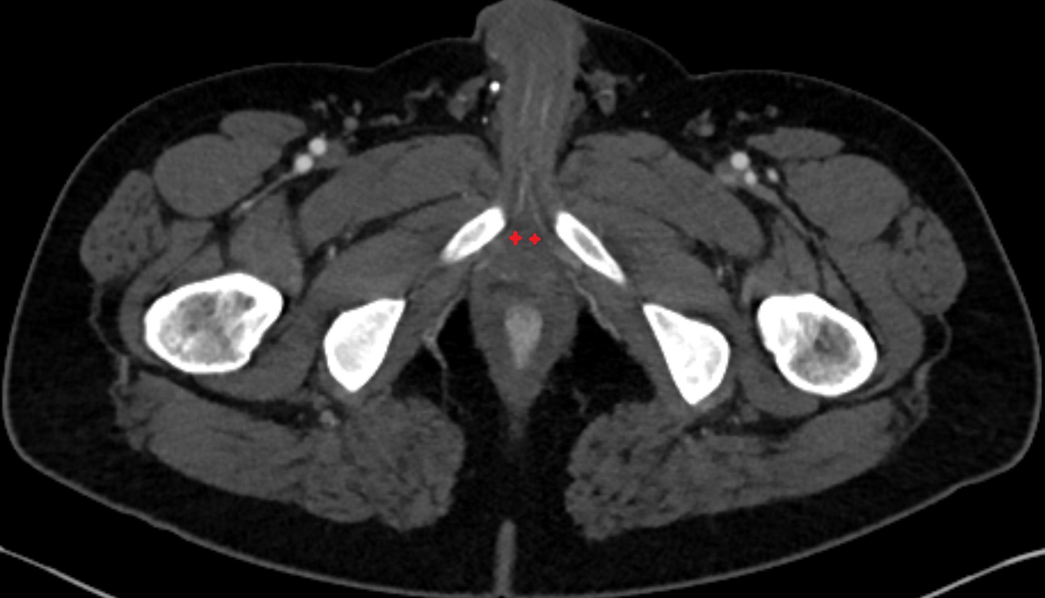 Bulb of Penis  ct axial  anatomy  image-img-00000-00000