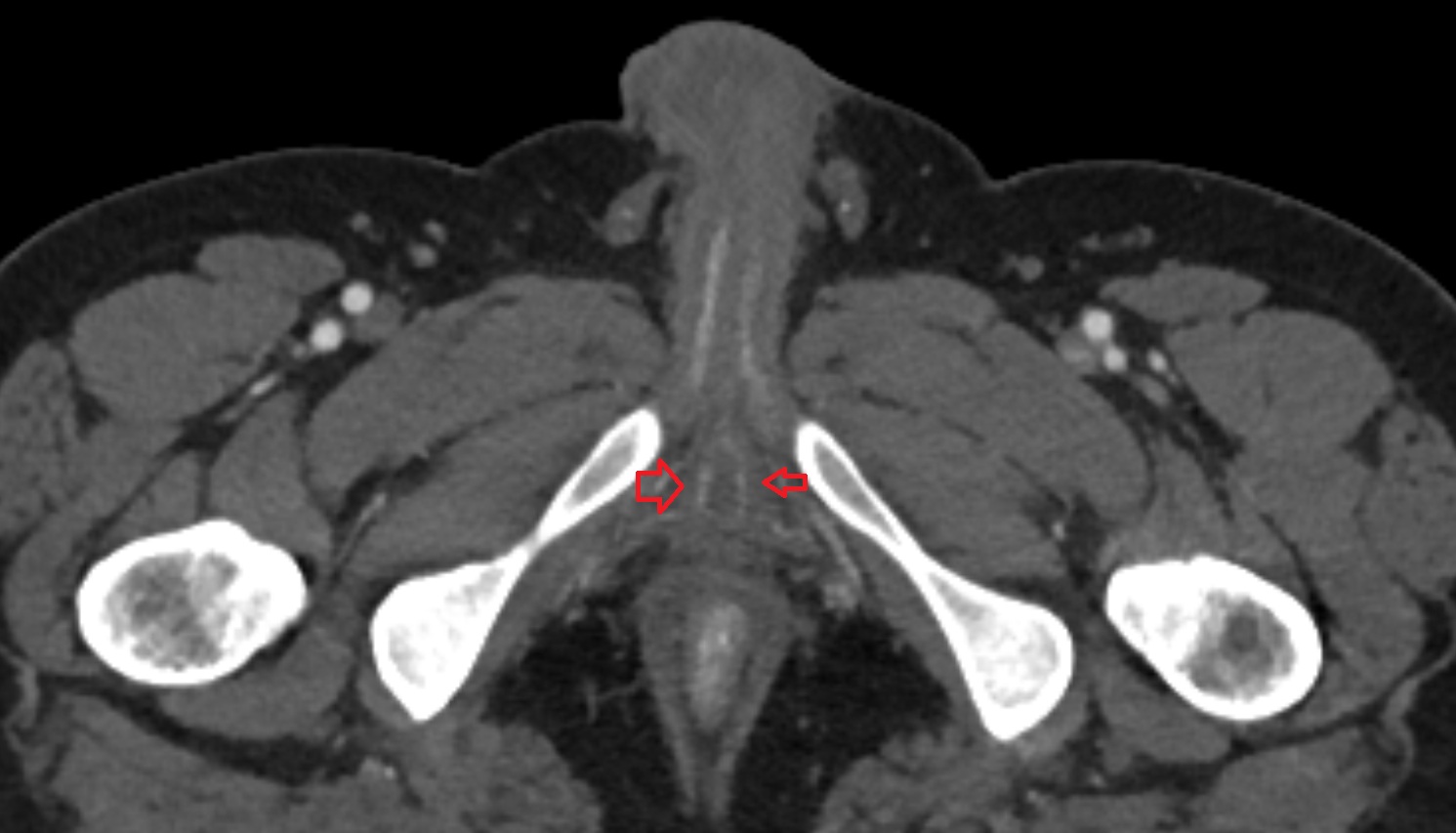 Bulbospongiosus muscle (Male)  CT  axial  anatomy  image-img-00000-00000