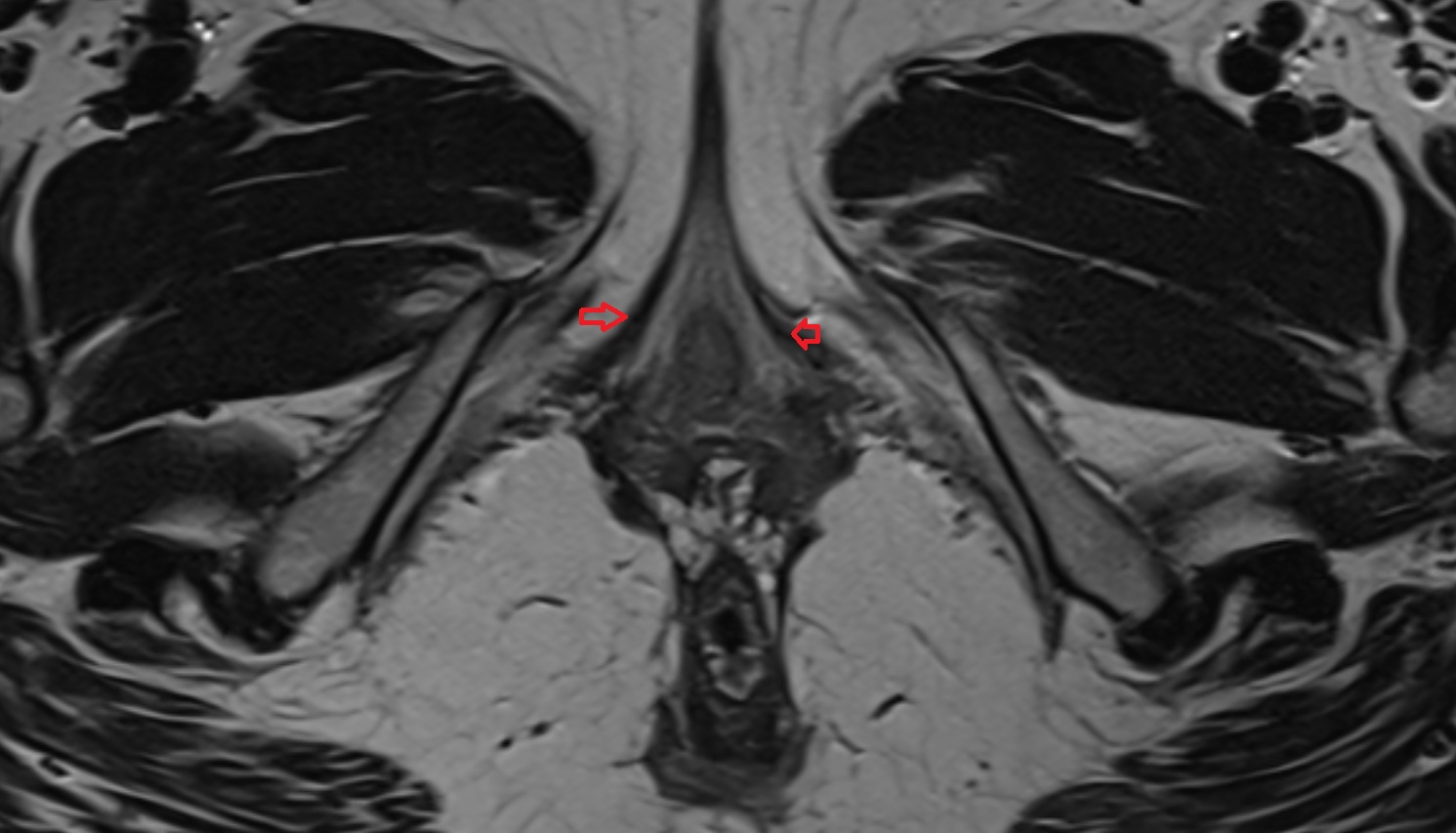 Bulbospongiosus muscle  female    MRI  axial  anatomy  image-img-00000-00000