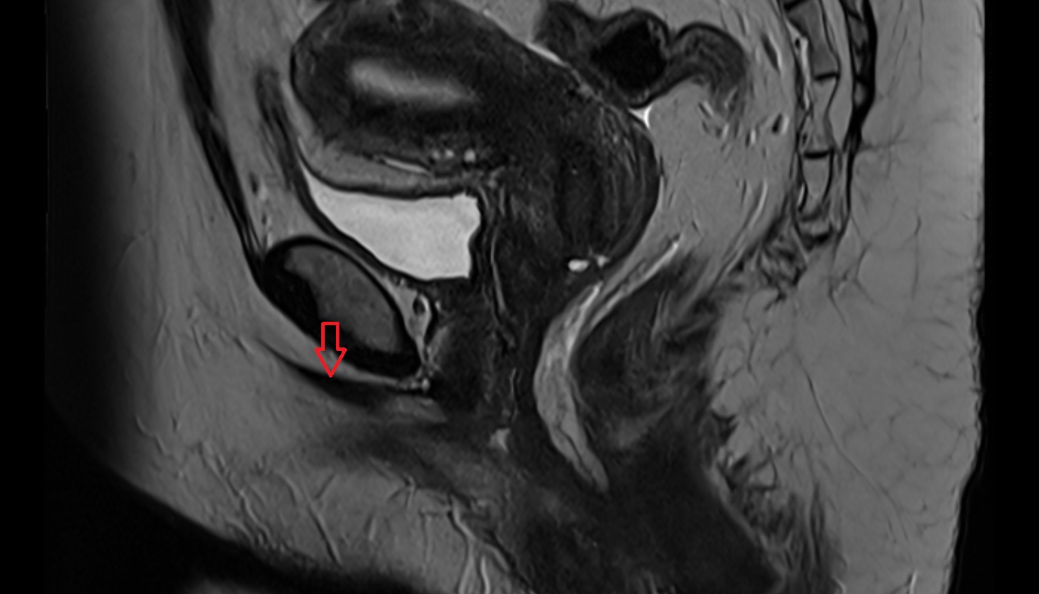 Bulbospongiosus muscle female    MRI sagitttal  anatomy  image-img-00000-00000