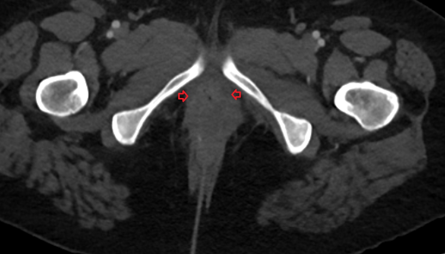 Bulbospongiosus muscle  female  ct  axial  anatomy  image-img-00000-00000