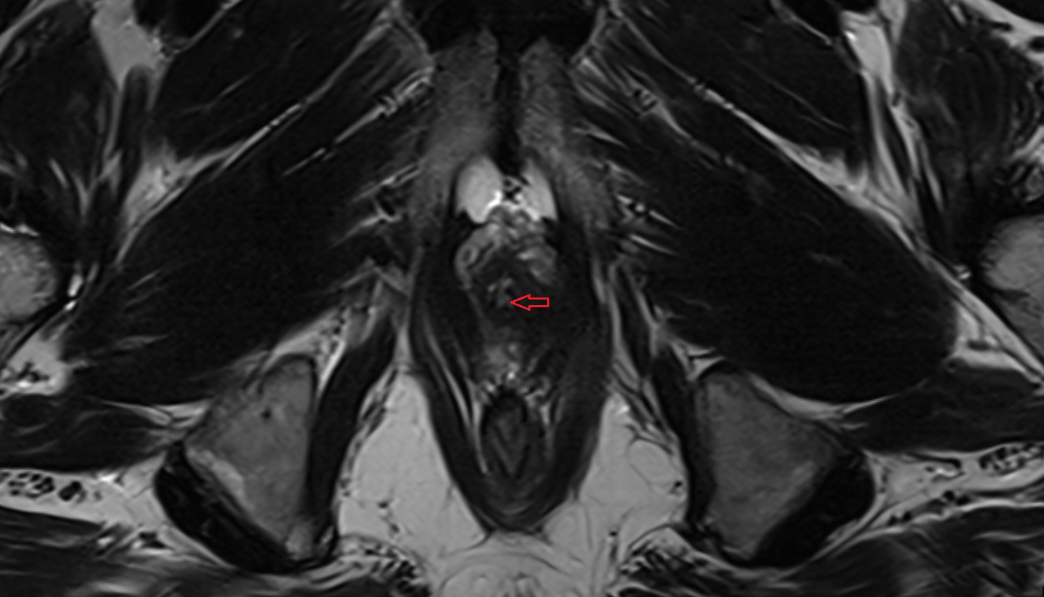 Bulbourethral gland mri axial  anatomy  image-img-00000-00000