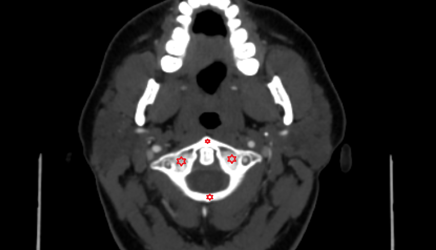 C1 Vertebra (Atlas) CT AXIAL Anatomy, Location and Imaging Appearance  -img-00000-00000