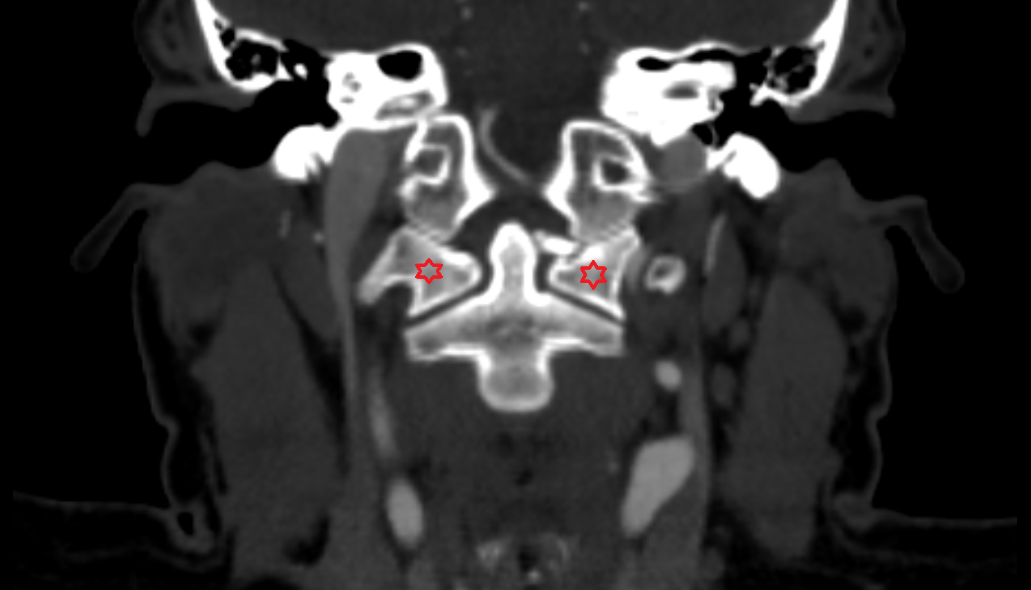 C1 Vertebra (Atlas) CT  coronal Anatomy, Location and Imaging Appearance  -img-00000-00000