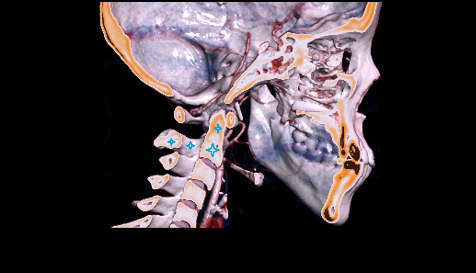 C2 Vertebra (Axis) 3D