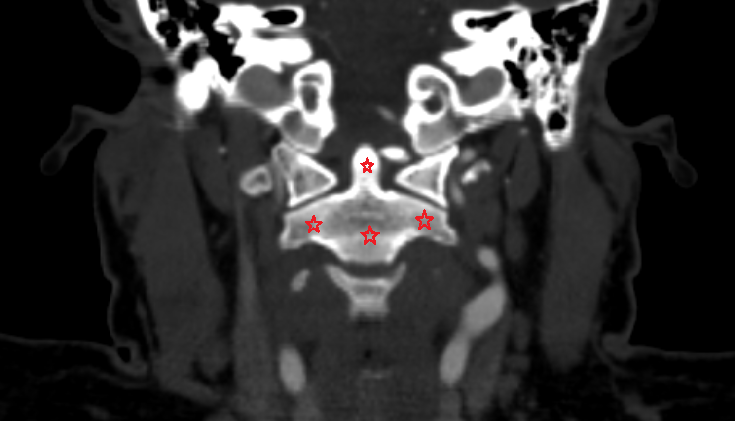 C2 Vertebra (Axis) CT CORANAL Anatomy, Location and Imaging Appearance  -img-00000-00000