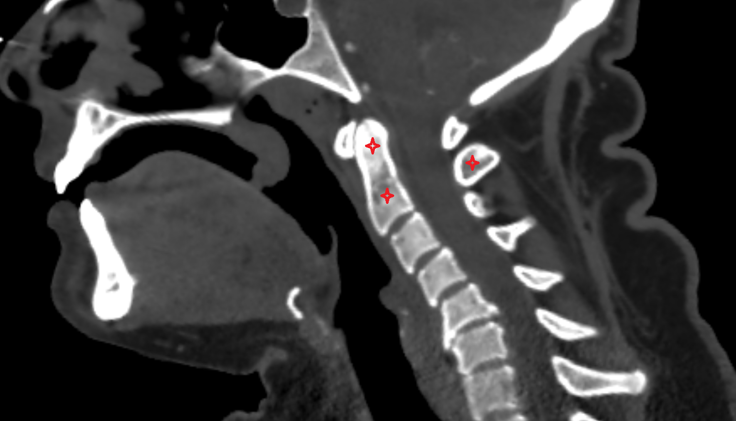 C2 Vertebra (Axis) CT SAG Anatomy, Location and Imaging Appearance  -img-00000-00000
