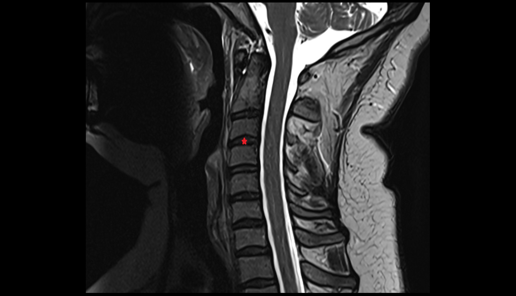 C3–C4 intervertebral disc