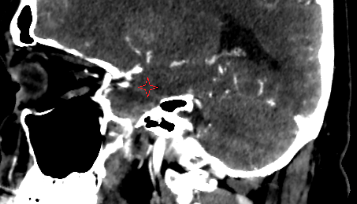 CT Amygdalohippocampal area sagittal anatomy image -img-00000-00000