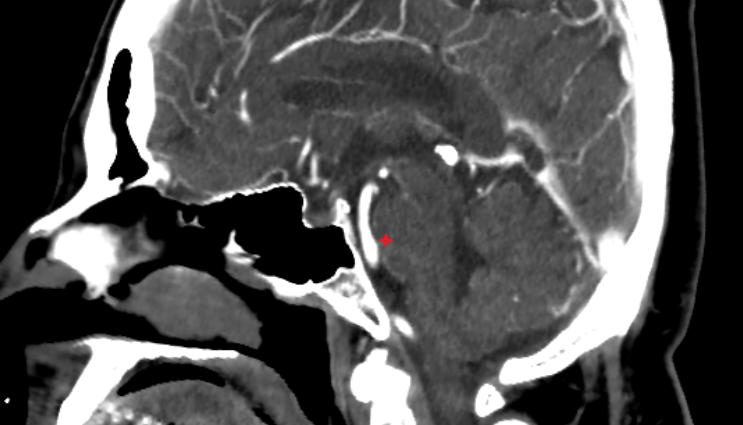 CT  Basilar part of pons anatomy image -img-00000-00000