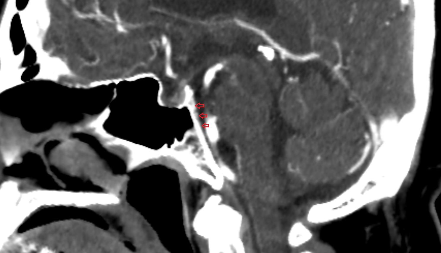 CT  Basilar venous plexus sag anatomy image -img-00000-00000