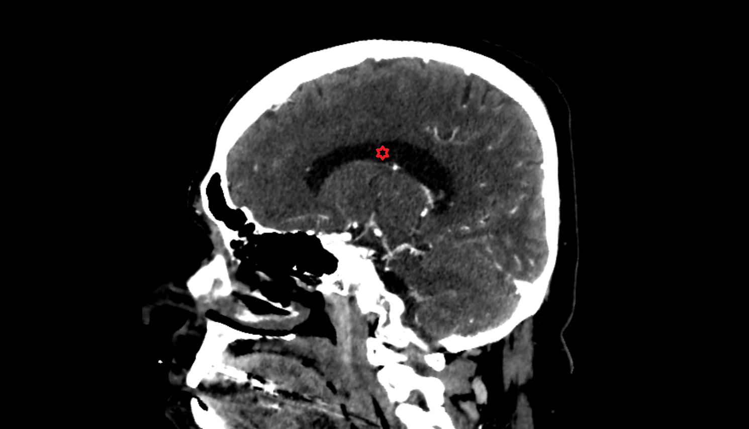 CT Body of lateral ventricle sag  anatomy image -img-00000-00000