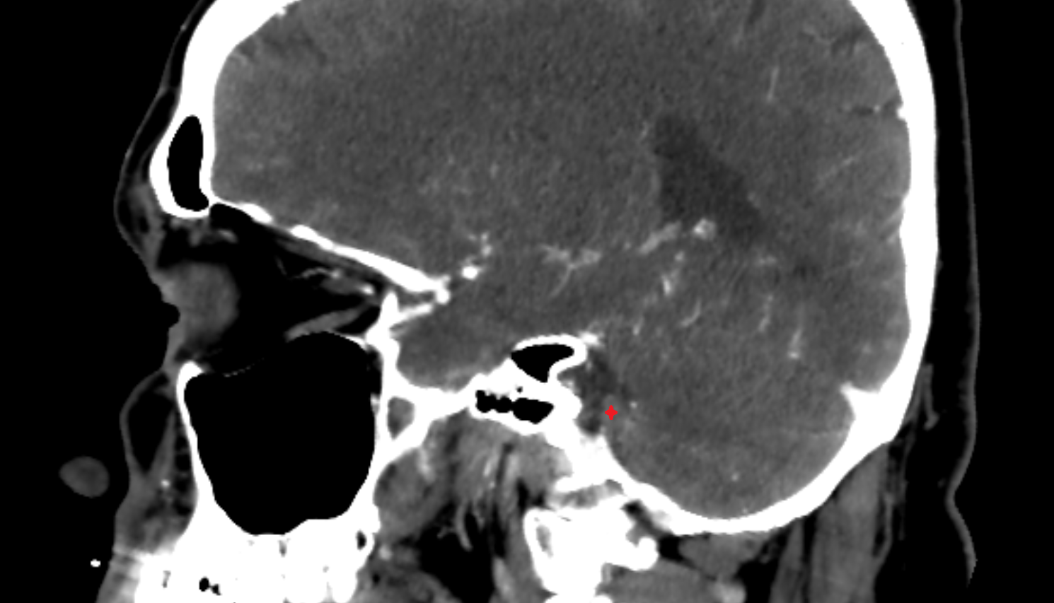 CT Flocculus sag anatomy image -img-00000-00000