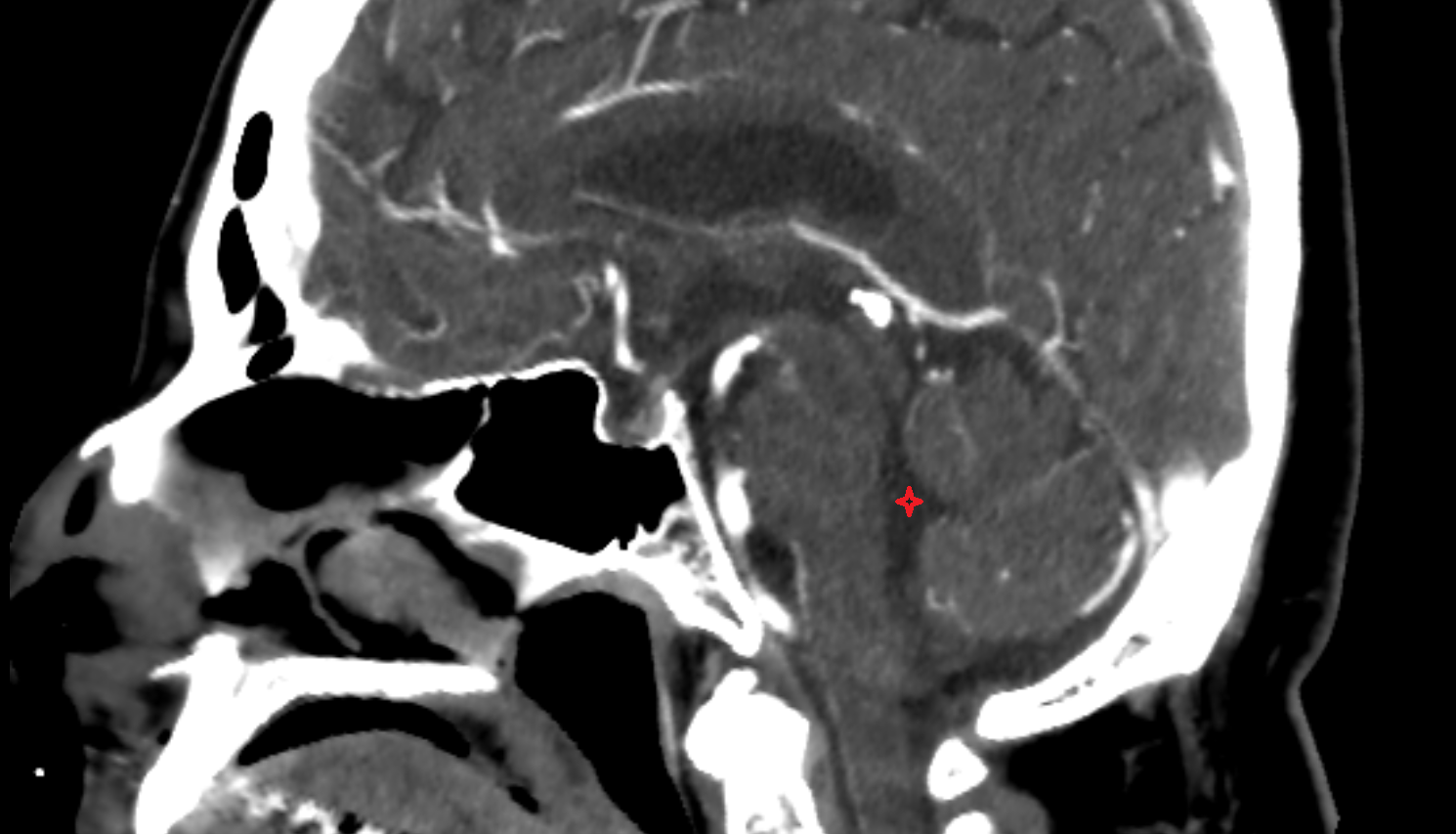 CT Fourth ventricle sag anatomy image -img-00000-00000