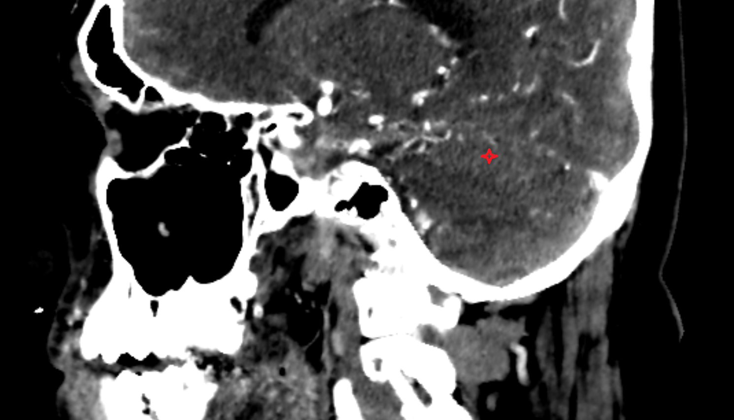 CT Posterior quadrangular lobule sag anatomy image -img-00000-00000