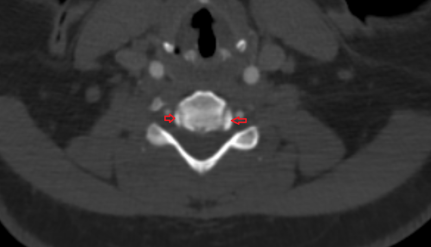 CT Uncinate process of vertebra of  vertebra , Location and Imaging Appearance  -img-00000-00000