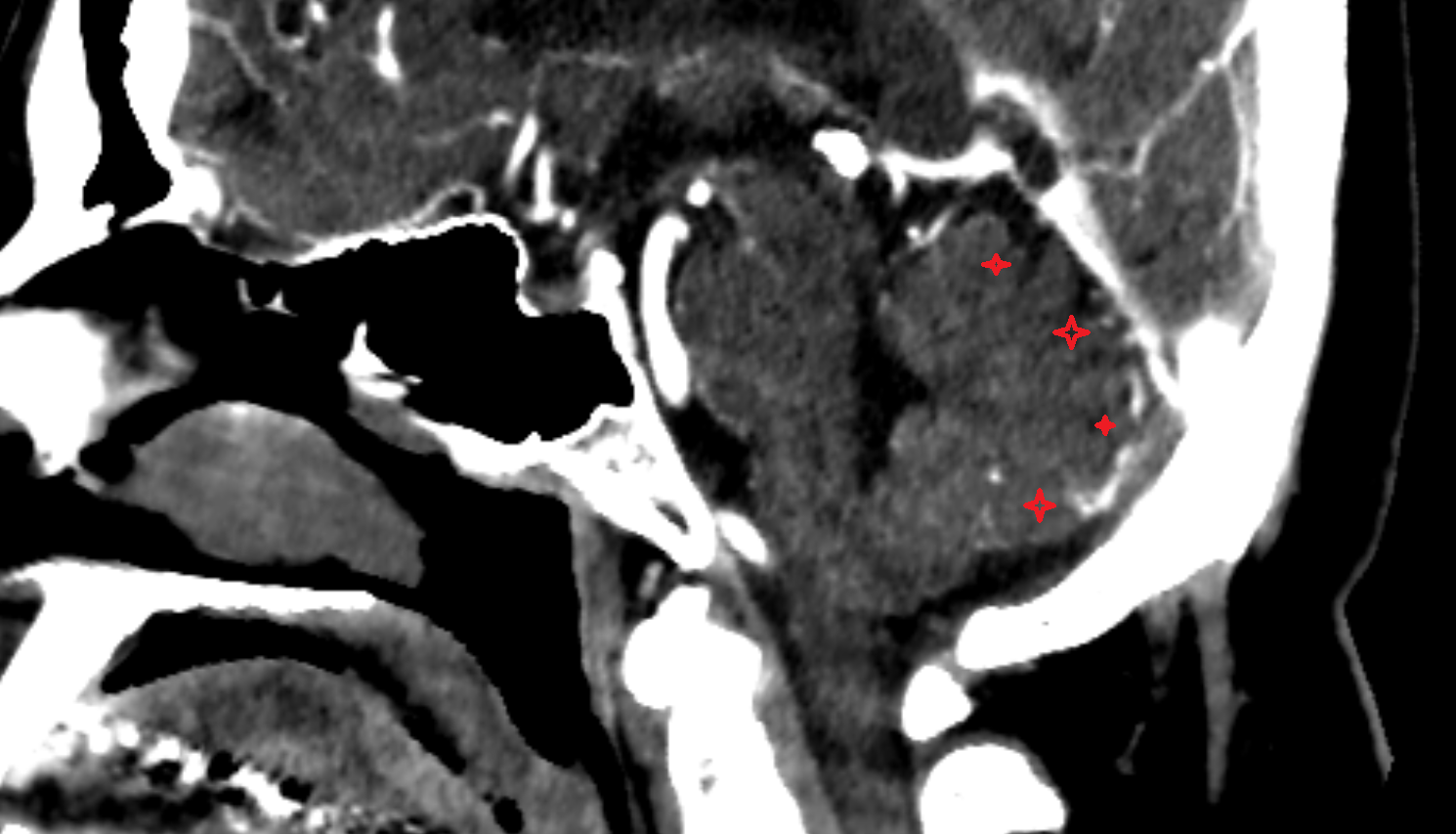 CT Vermis of cerebellum sag anatomy image -img-00000-00000