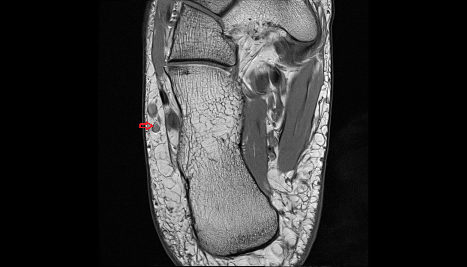 Calcaneal perforator veins veins  AXIAL  cross sectional anatomy 3T MRI AI enhanced radiology image-img-00000-00000