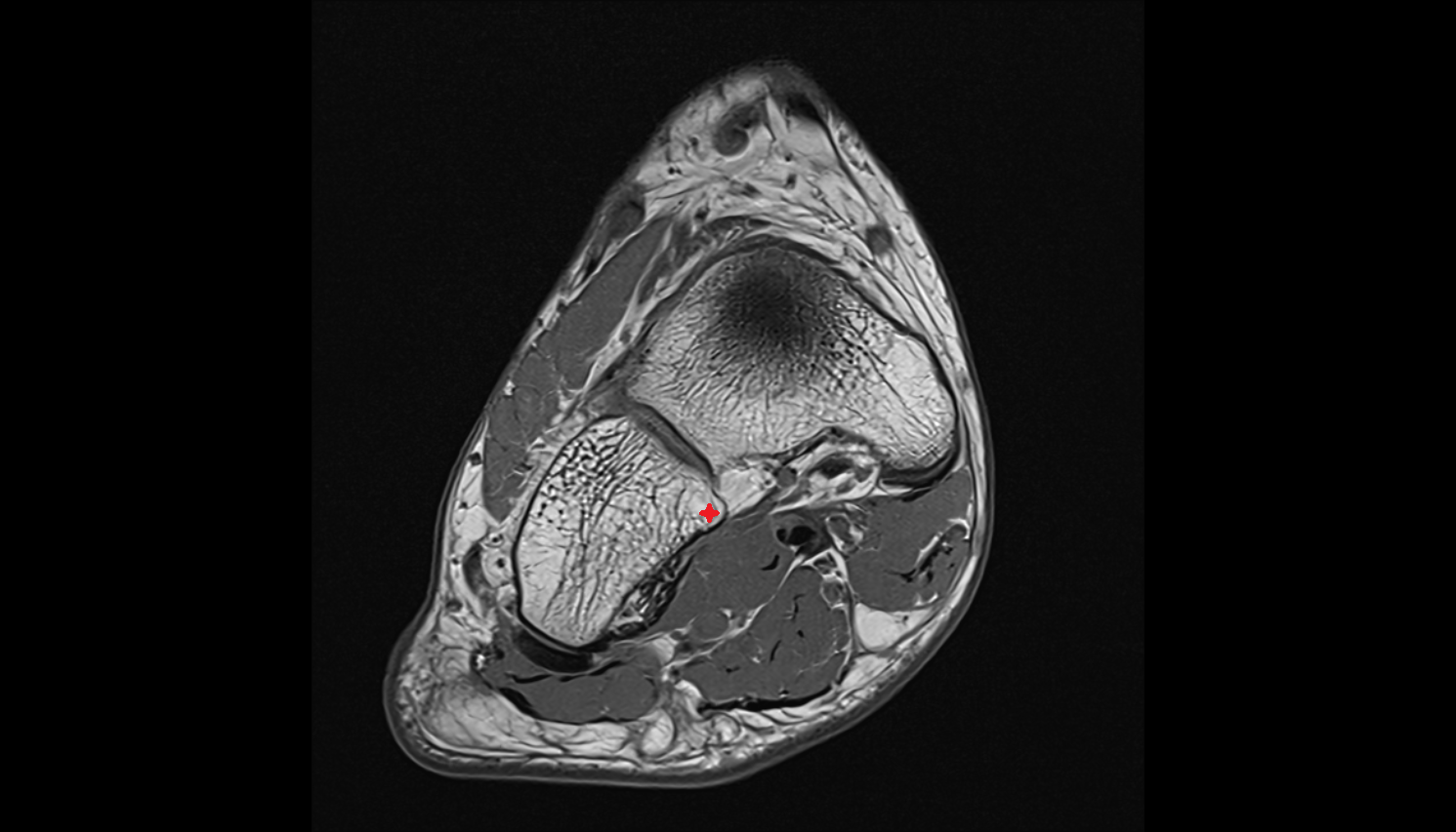 Calcaneal process of cuboid bone  MRI axial  cross sectional anatomy 3T MRI AI enhanced radiology image-img-00000-00000