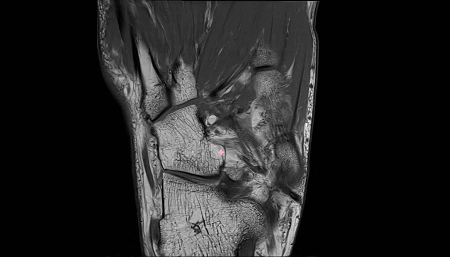 Calcaneal process of cuboid bone  MRI axial  cross sectional anatomy 3T MRI AI enhanced radiology image-img-00000-00000_00001