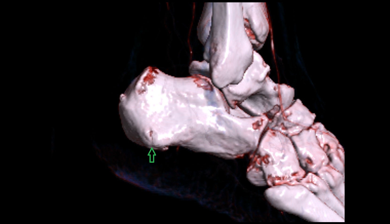 Calcaneal tubercle 3d