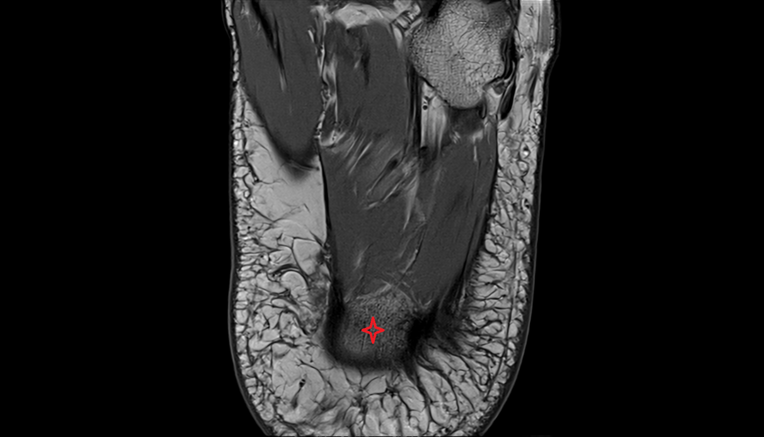 Calcaneal tubercle  mri  anatomy labelled image-img-00000-00000